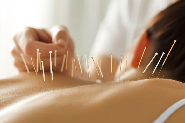 Acupuncture Therapy